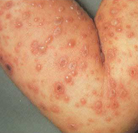 水痘第二次起是怎么回事 水痘第二次起是怎么回事