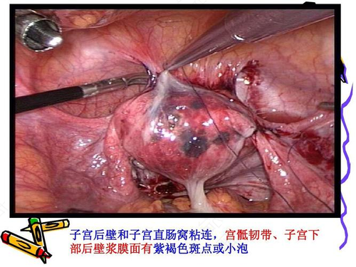 子宫直肠窝是指哪里 子宫直肠窝是指哪里