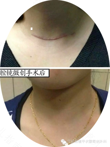 甲状腺结节怎样治疗好 甲状腺结节怎样治疗好