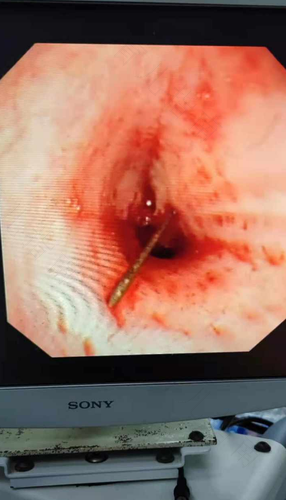 一咳嗽就吐血是怎么回事啊 一咳嗽就吐血是怎么回事啊