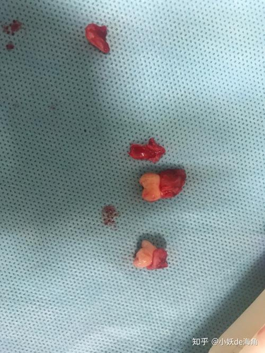 拔牙后麻药多久消失会痛吗 拔牙后麻药多久消失会痛吗