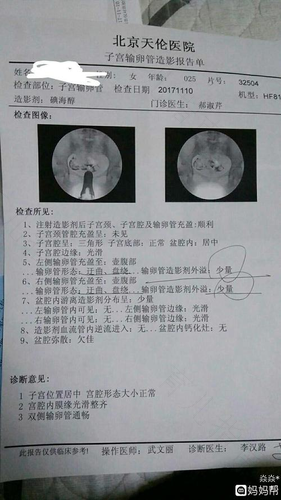 输卵管检查一般什么时候做最好 输卵管检查一般什么时候做最好