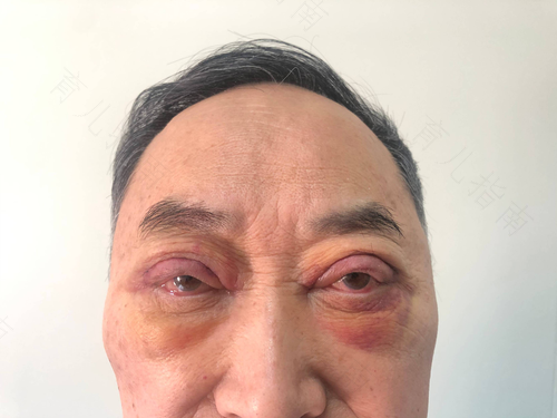 70岁老人眼睛水肿怎么回事 70岁老人眼睛水肿怎么回事