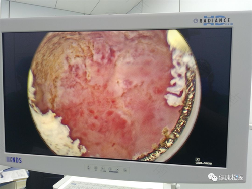 子宫内膜息肉手术怎么做的 子宫内膜息肉手术怎么做的