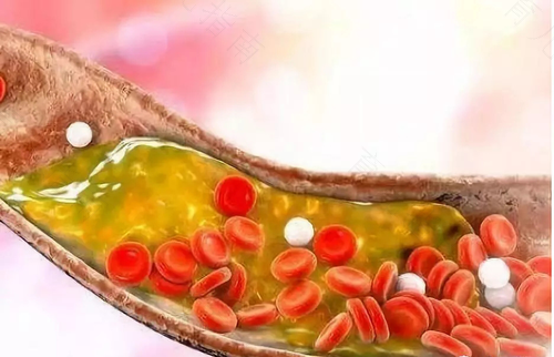 胆固醇高有没有危害 胆固醇高有没有危害