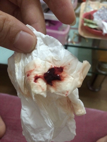 乳房挤出来血怎么回事 乳房挤出来血怎么回事