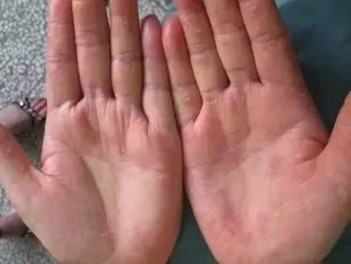 湿疹不治疗会好吗 湿疹不治疗会好吗