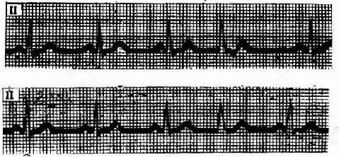 心律不齐早搏怎么办怎么预防 心律不齐早搏怎么办怎么预防