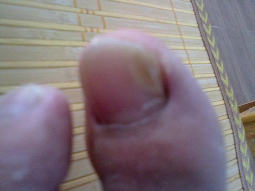 脚指甲变黄变空怎么治疗 脚指甲变黄变空怎么治疗