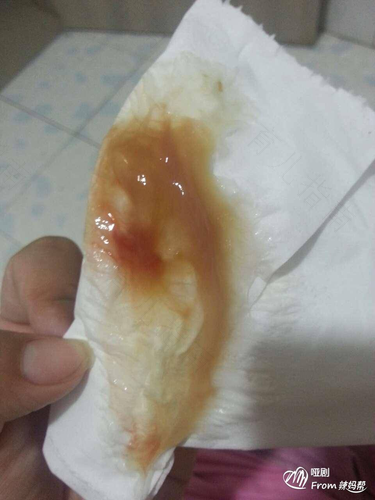 白带有酸奶味是怎么回事