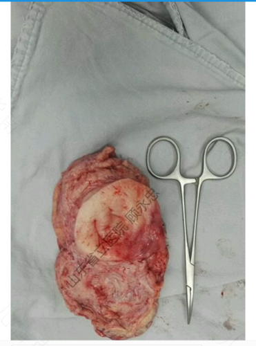 子宫切除后感染了怎么办