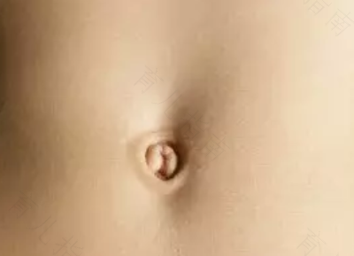 肚脐发炎总是好不了怎么办 肚脐发炎总是好不了怎么办