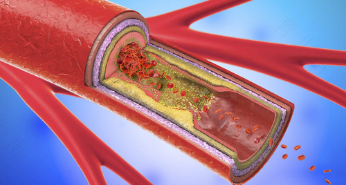 腿部动脉硬化的原因及治疗方法 腿部动脉硬化的原因及治疗方法