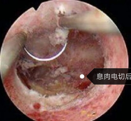 宫腔镜后感染有什么症状 宫腔镜后感染有什么症状