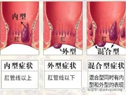 有痔疮会不会引起肛门痒 有痔疮会不会引起肛门痒