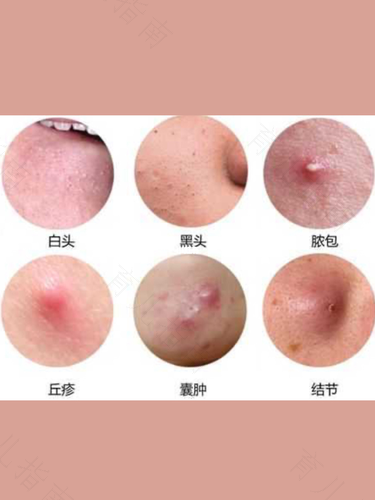 小孩皮肤过敏了怎么办最简单 小孩皮肤过敏了怎么办最简单