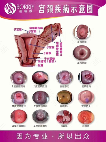 宫颈糜烂一度二度用治疗吗 宫颈糜烂一度二度用治疗吗
