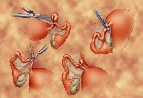 输卵管扭曲手术怎么做的