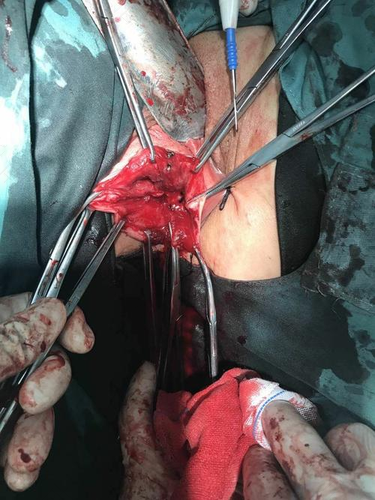 子宫下垂做手术有没有什么影响