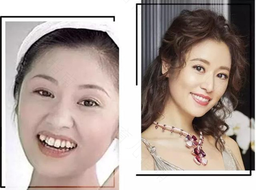 30岁矫正牙齿要多久时间 30岁矫正牙齿要多久时间