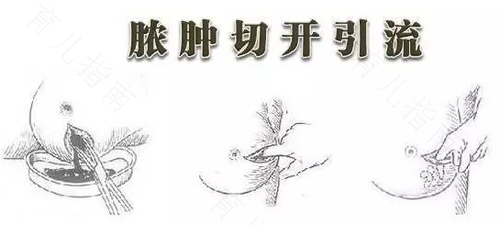 乳腺炎形成脓肿的症状 乳腺炎形成脓肿的症状