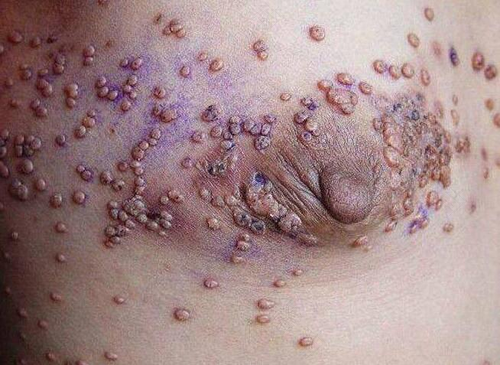 艾滋病早期必有的症状图片 艾滋病早期必有的症状图片