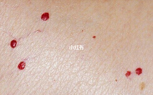 老人身上有红点是怎么回事 老人身上有红点是怎么回事