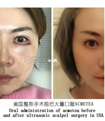 做眼部线雕有副作用吗 做眼部线雕有副作用吗