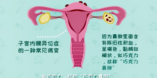 什么是卵巢巧克力囊肿