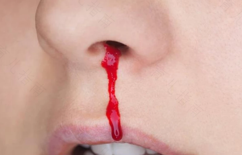 挖鼻屎挖出血了怎么办