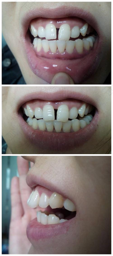 儿童门牙太宽太大怎么办 儿童门牙太宽太大怎么办