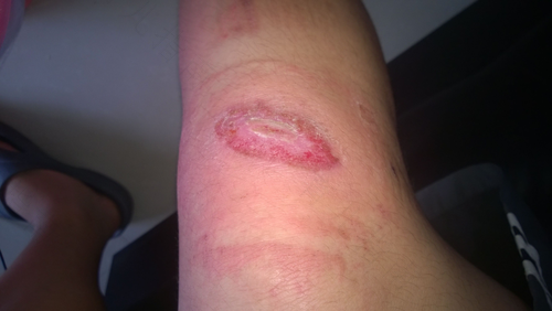 打破伤风针眼周围发痒发红怎么处理 打破伤风针眼周围发痒发红怎么处理