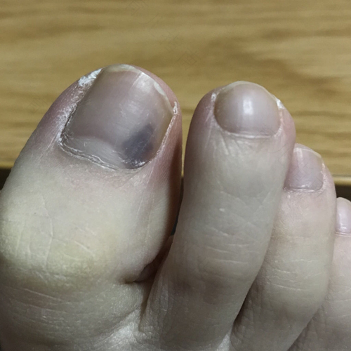 脚趾甲里有淤血怎么办,按着很痛 脚趾甲里有淤血怎么办,按着很痛