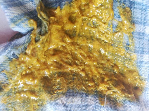 大便是白色的是什么原因 大便是白色的是什么原因