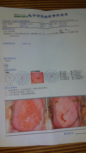 宫颈糜烂会有什么反应 宫颈糜烂会有什么反应