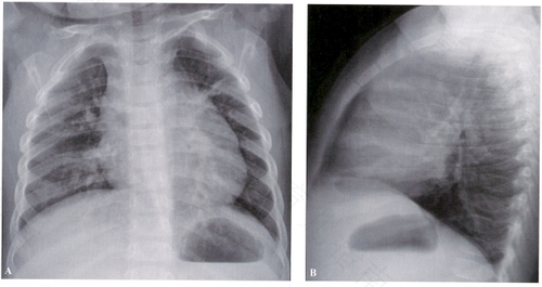 胸壁结核传染吗? 胸壁结核传染吗?