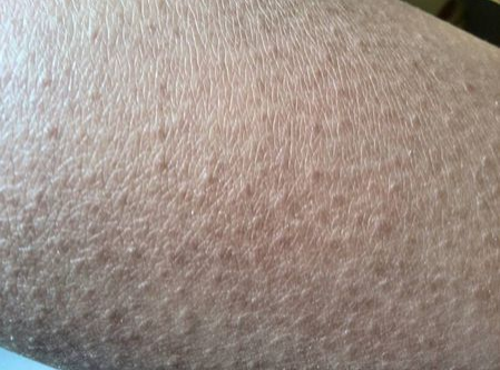 腿上毛囊炎疙瘩怎么治疗