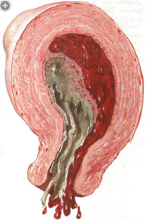 宝宝宫内感染怎么引起的 宝宝宫内感染怎么引起的