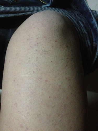 背上到晚上很痒怎么回事 背上到晚上很痒怎么回事