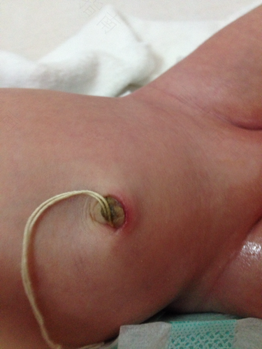 女性肚脐眼发炎怎么办 女性肚脐眼发炎怎么办