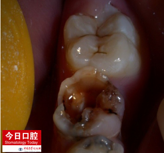 儿童龋齿需要治疗吗 儿童龋齿需要治疗吗