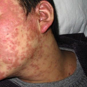 红斑狼疮的人能结婚吗 红斑狼疮的人能结婚吗