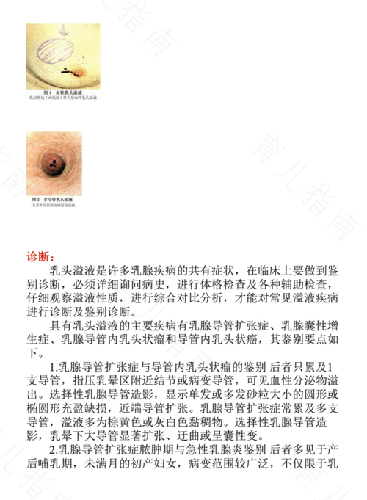 双侧乳头溢液常见于什么病 双侧乳头溢液常见于什么病