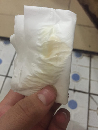 褐色拉丝分泌物怎么回事 褐色拉丝分泌物怎么回事