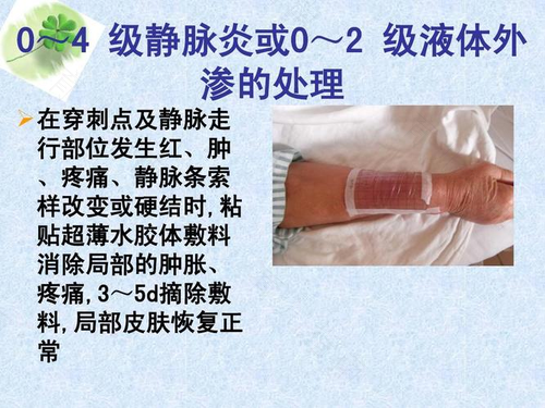 增强ct造影剂渗漏怎么处理 增强ct造影剂渗漏怎么处理