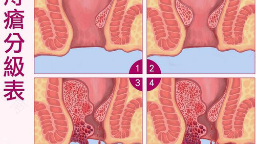 怎么判断痔疮严不严重 怎么判断痔疮严不严重