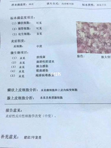 宫颈光是什么意思? 宫颈光是什么意思?