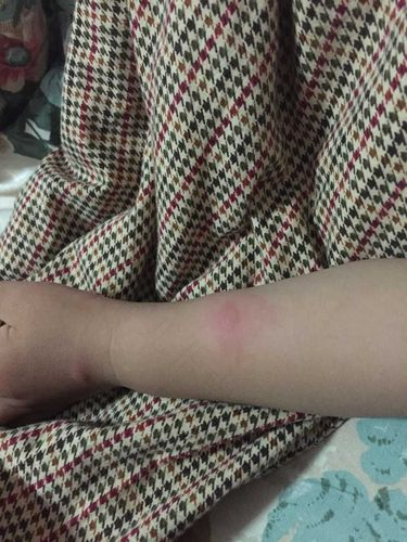 治慢性荨麻疹要怎么治疗