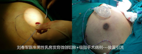 副乳太大可以切除吗 副乳太大可以切除吗