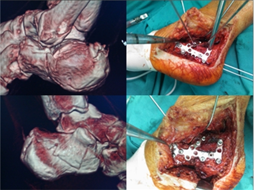 什么是关节内骨折 什么是关节内骨折